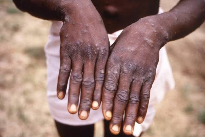 Top Stories Tamfitronics Mpox Outbreak: 10,000 Doses to Reach Nigeria by September as Cases Increase to 40